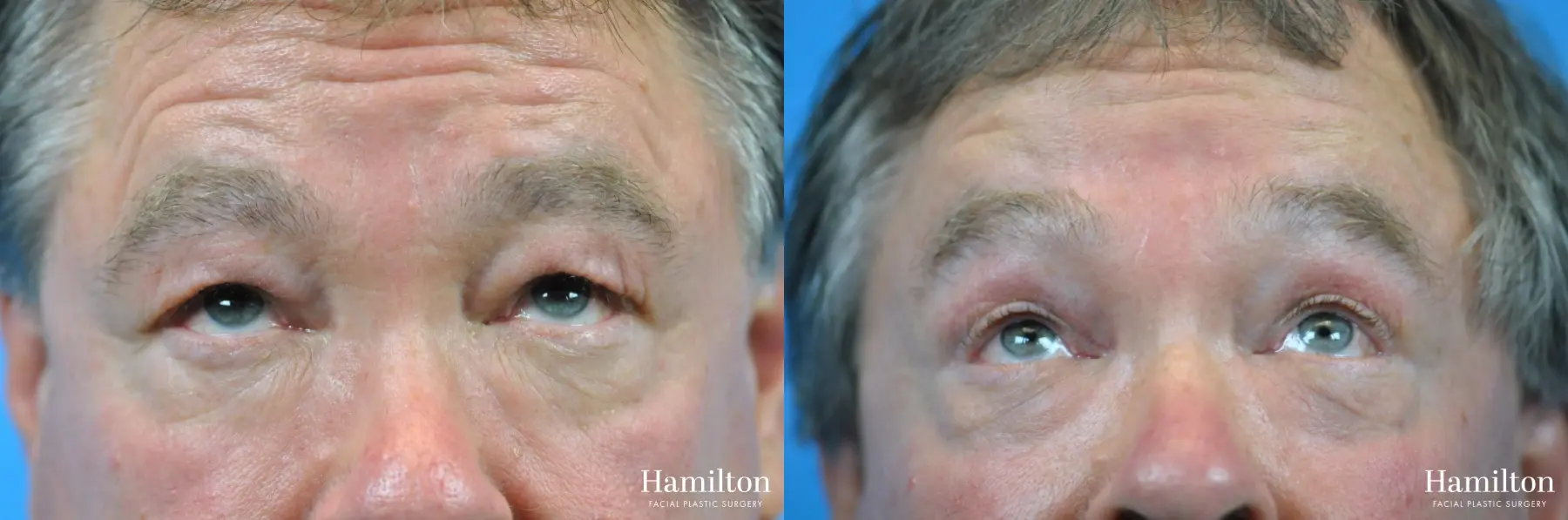 Blepharoplasty: Patient 19 - Before and After 4