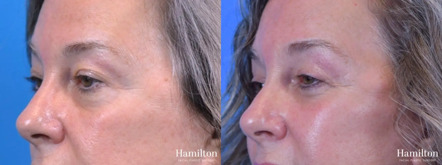 Blepharoplasty: Patient 14 - Before and After 2