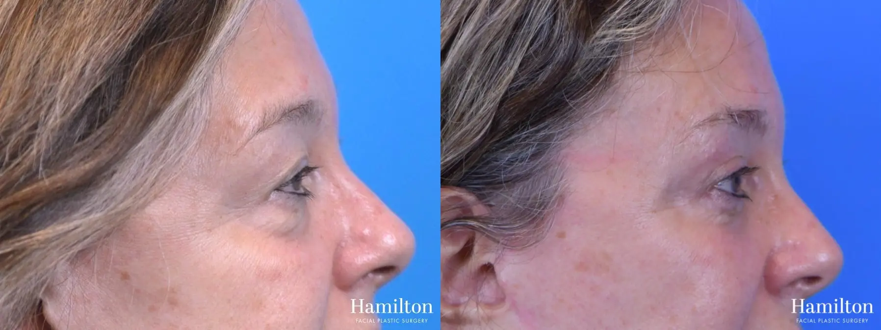 Blepharoplasty: Patient 14 - Before and After 4