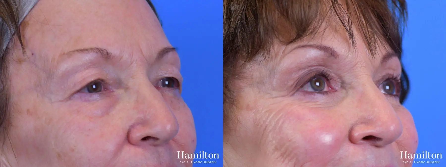 Blepharoplasty: Patient 13 - Before and After 5