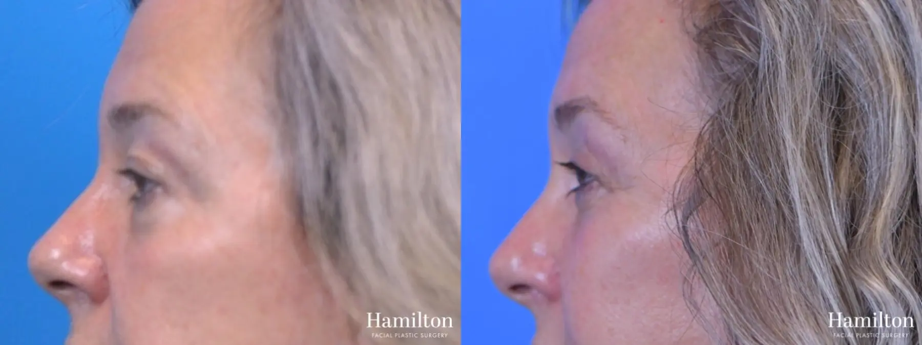 Blepharoplasty: Patient 14 - Before and After 5