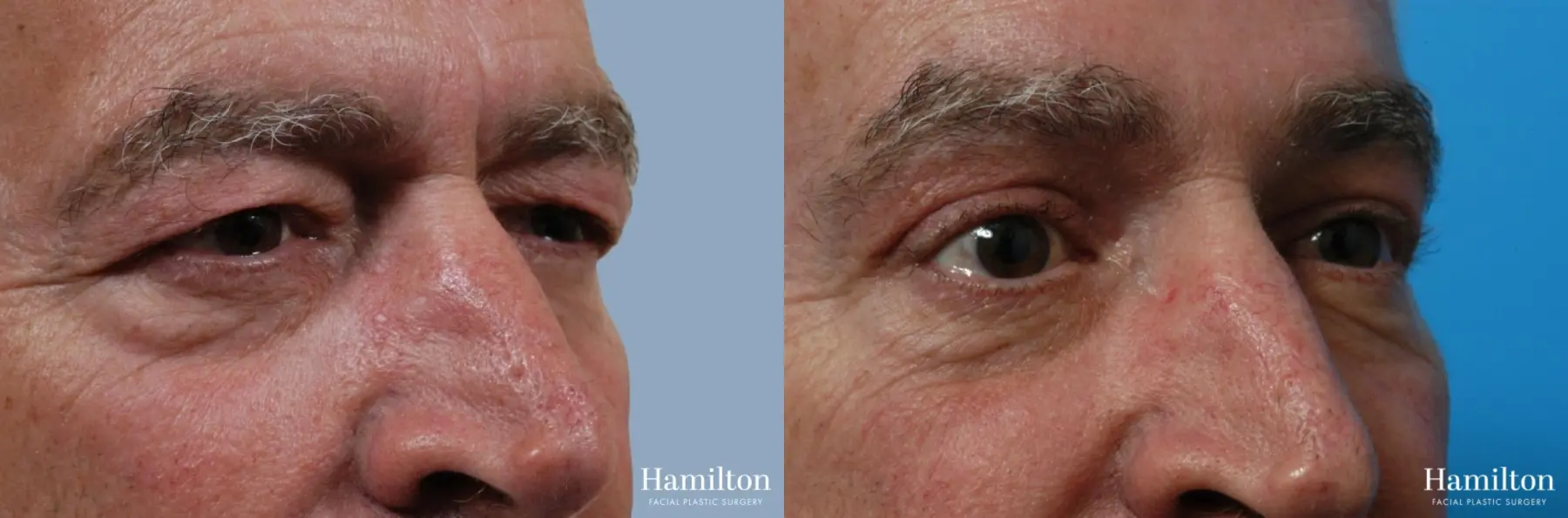 Blepharoplasty: Patient 24 - Before and After 3