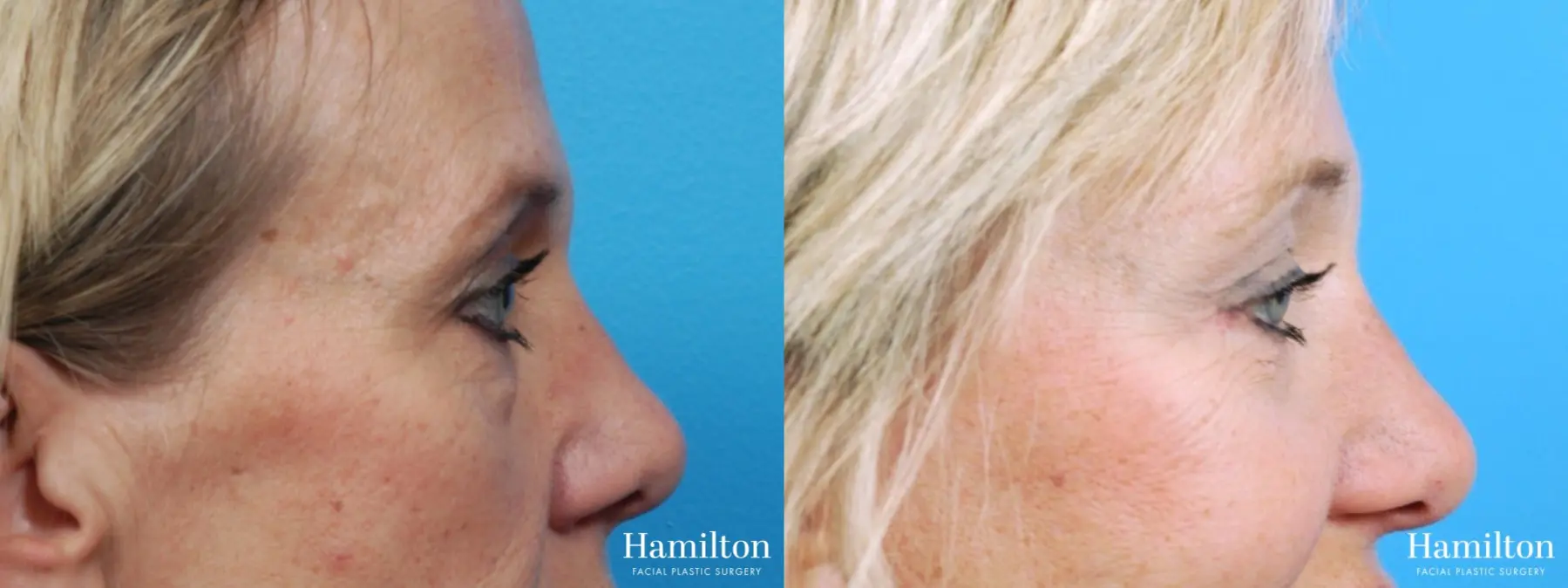 Blepharoplasty: Patient 8 - Before and After 3