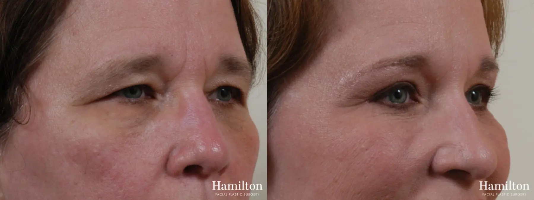 Blepharoplasty: Patient 7 - Before and After 4