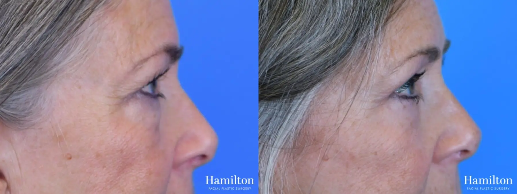 Blepharoplasty: Patient 12 - Before and After 4