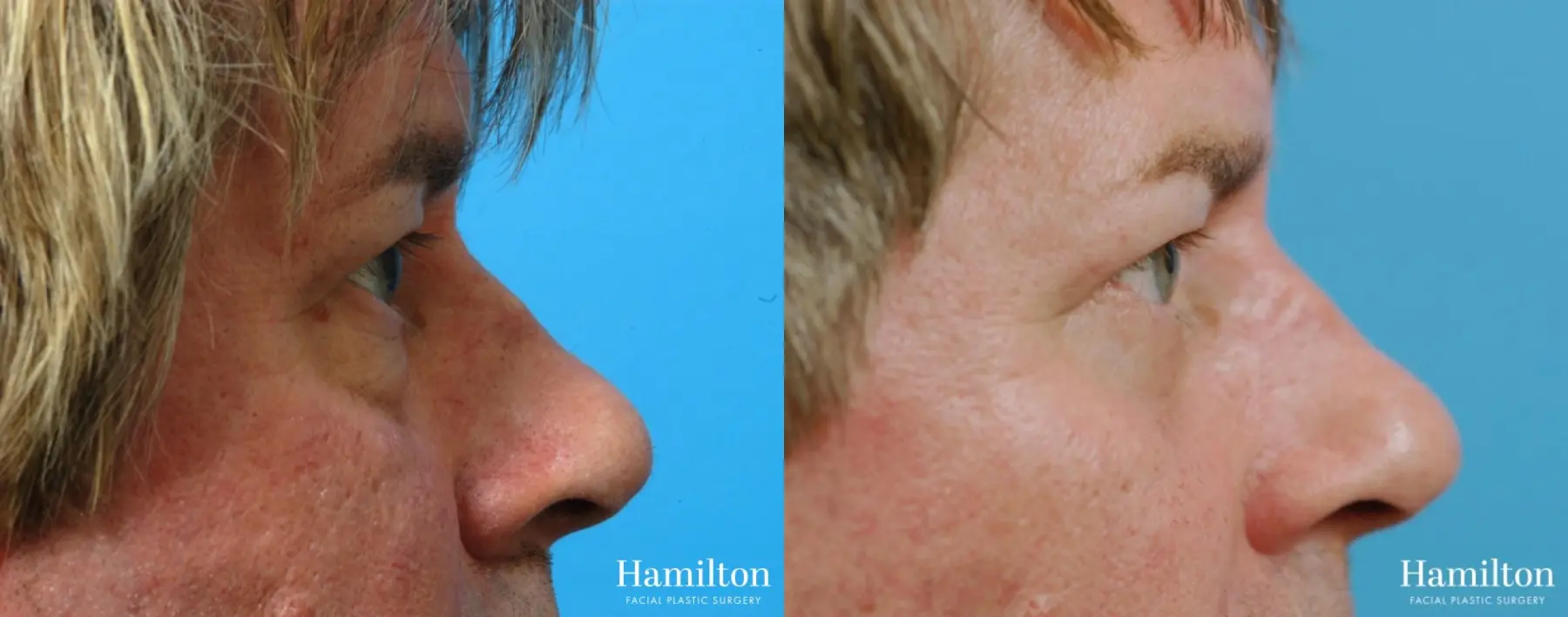 Blepharoplasty: Patient 23 - Before and After 5