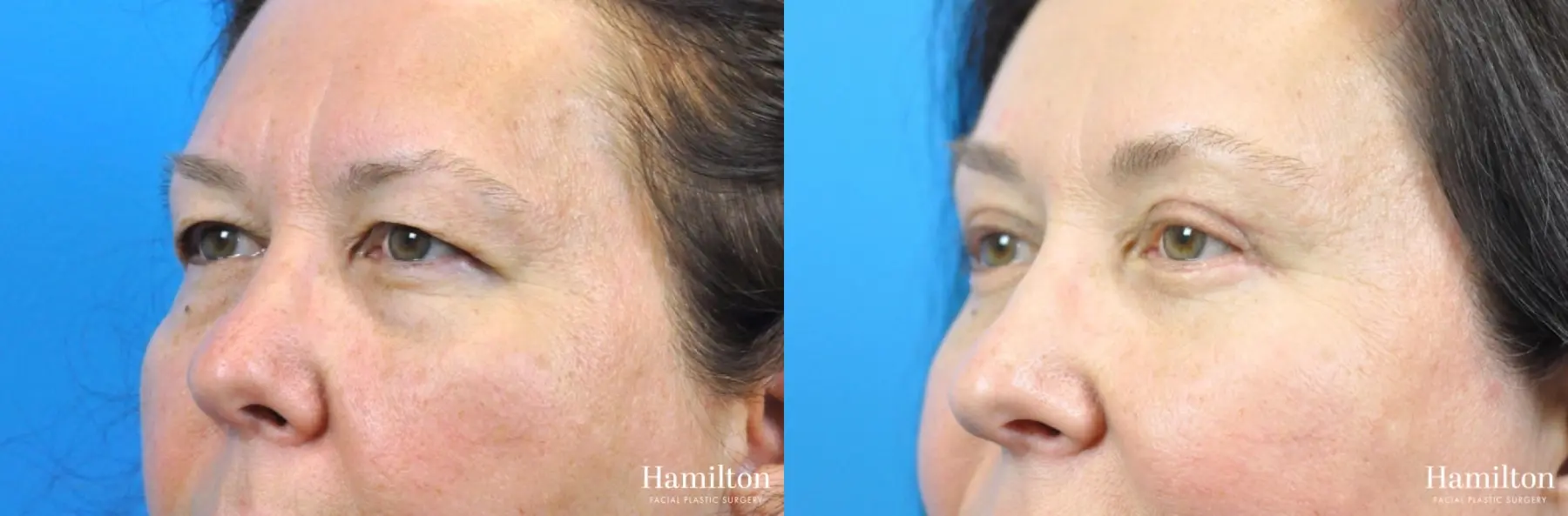 Blepharoplasty: Patient 21 - Before and After 4