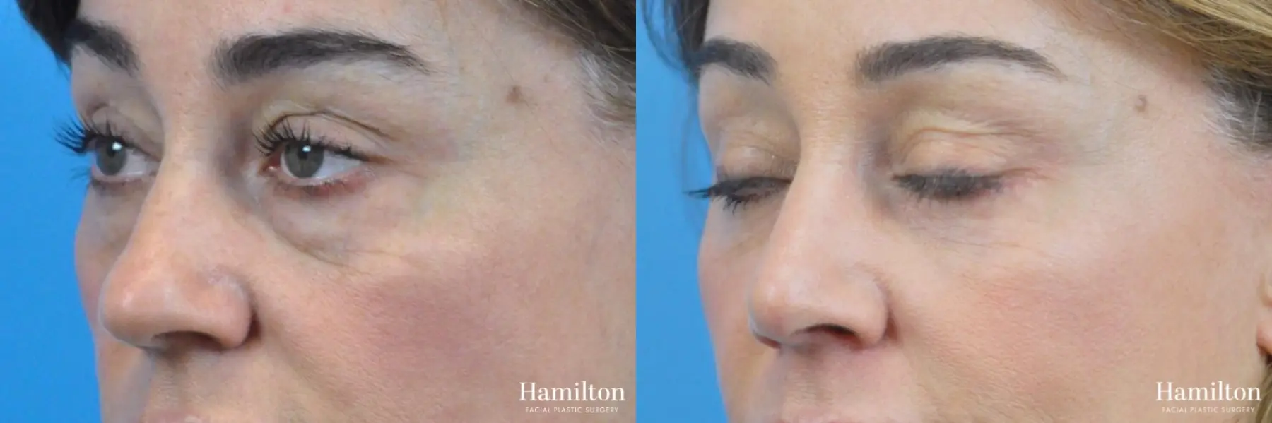 Blepharoplasty: Patient 25 - Before and After 4