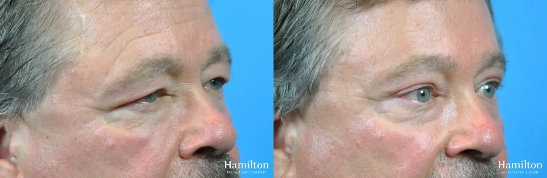 Blepharoplasty: Patient 19 - Before and After 1