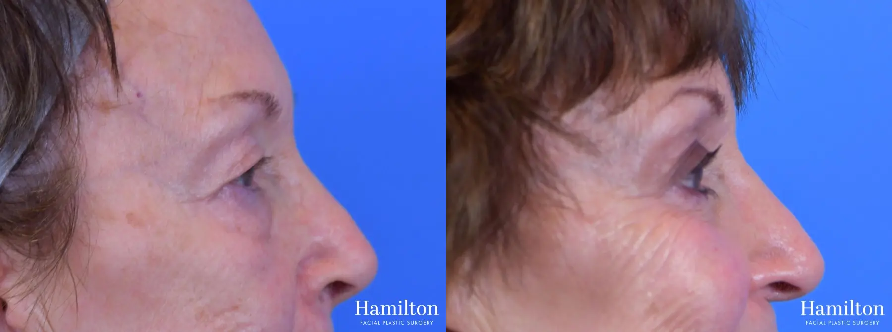 Blepharoplasty: Patient 13 - Before and After 3