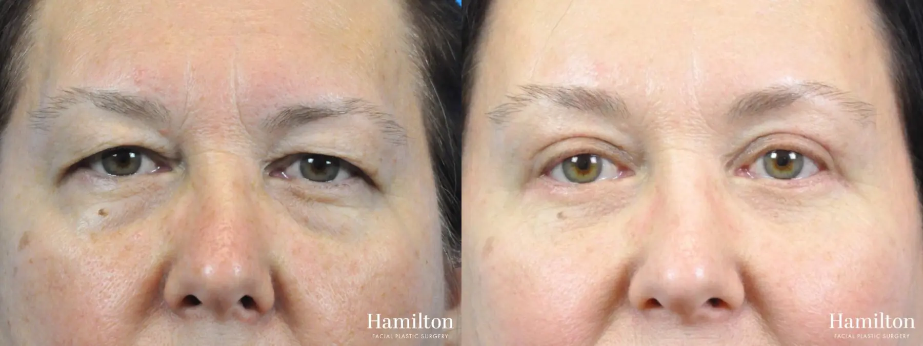 Blepharoplasty: Patient 21 - Before and After 1