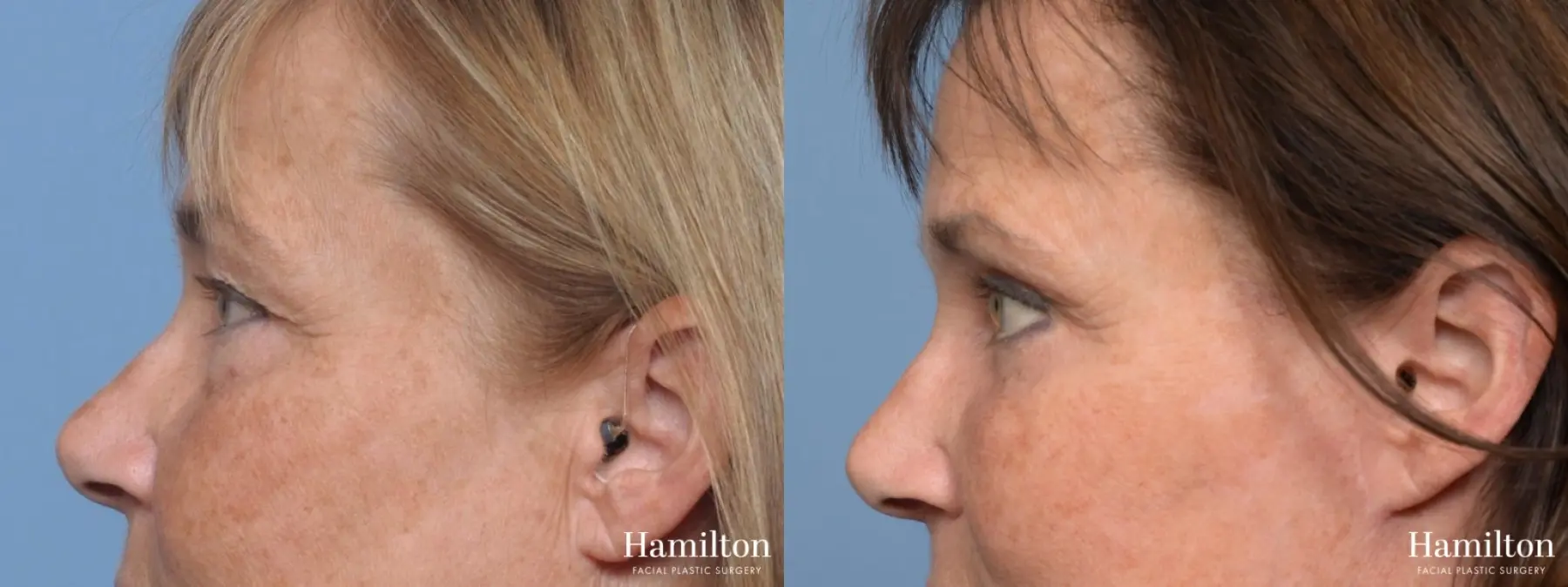 Blepharoplasty: Patient 2 - Before and After 5