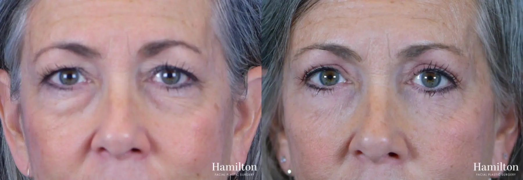 Blepharoplasty: Patient 12 - Before and After 1