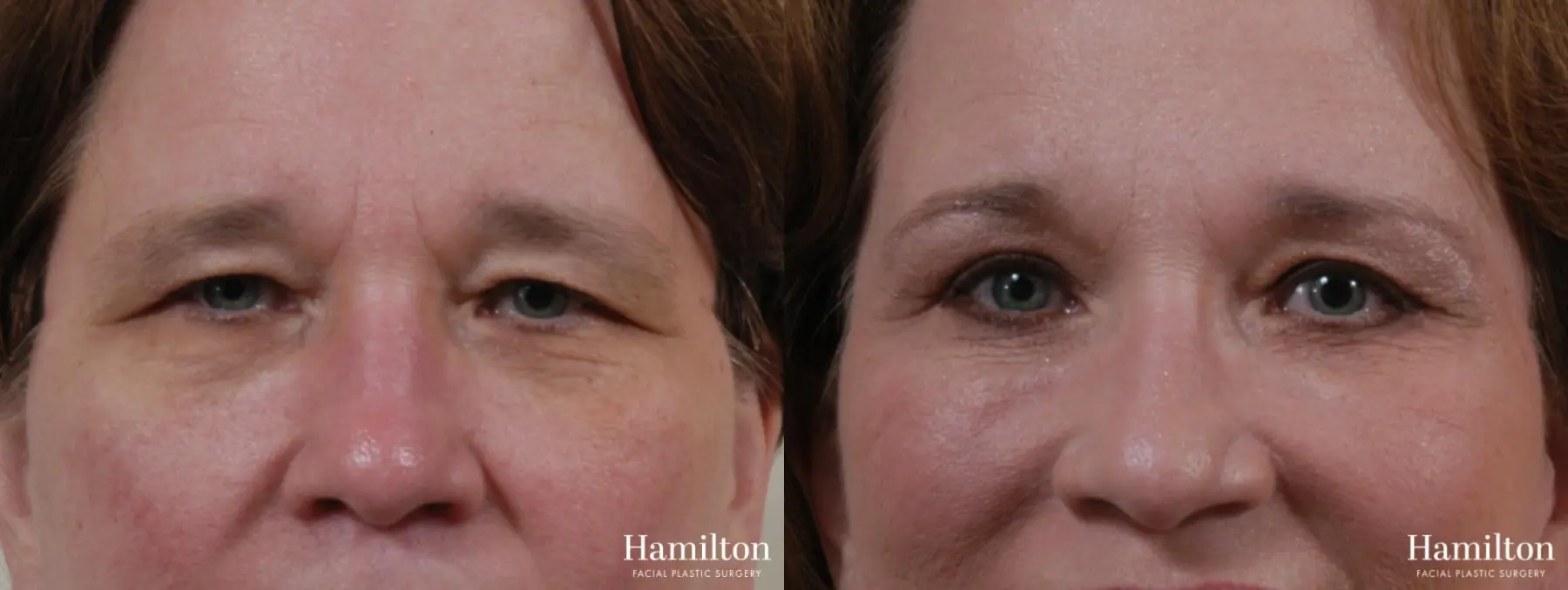 Blepharoplasty: Patient 7 - Before and After  