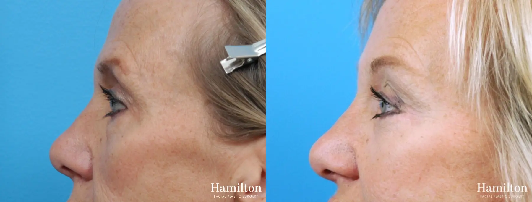 Blepharoplasty: Patient 8 - Before and After 2