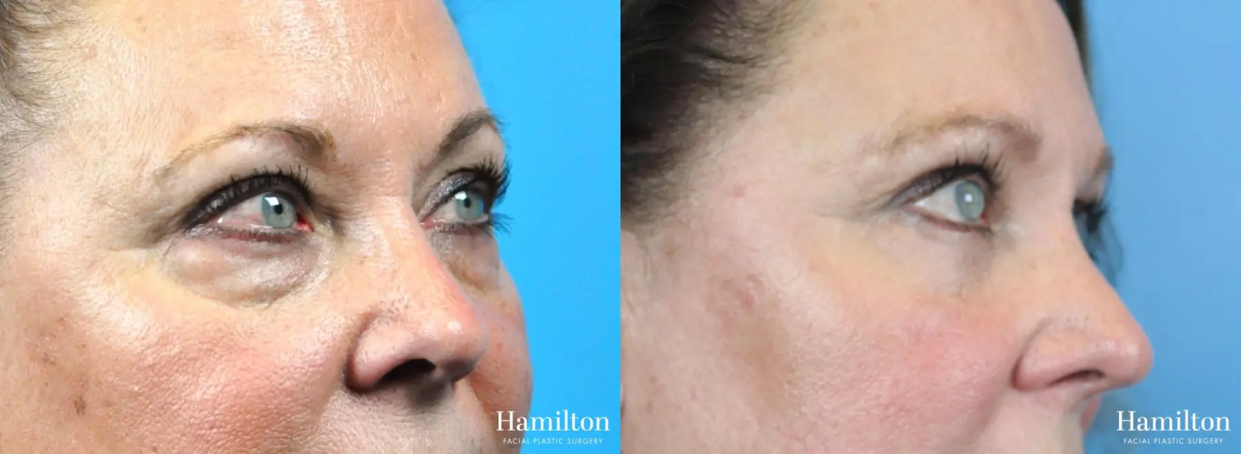 Blepharoplasty: Patient 27 - Before and After 2