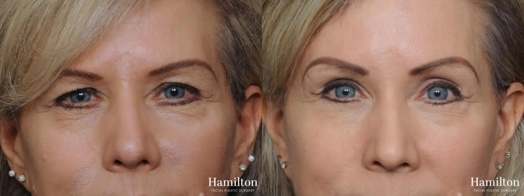 Blepharoplasty: Patient 5 - Before and After 3