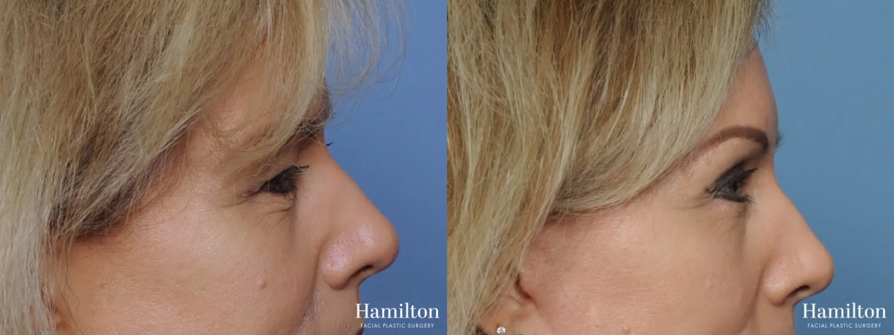 Blepharoplasty: Patient 5 - Before and After 5