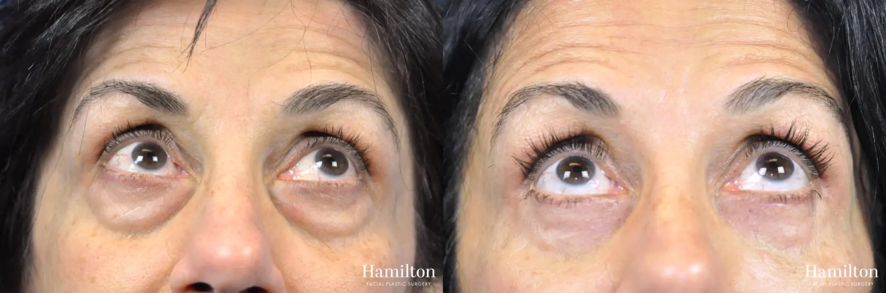 Blepharoplasty: Patient 10 - Before and After  