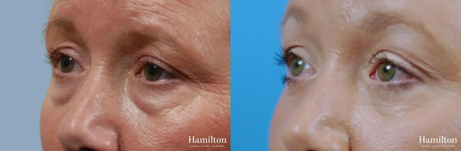 Blepharoplasty: Patient 11 - Before and After 3