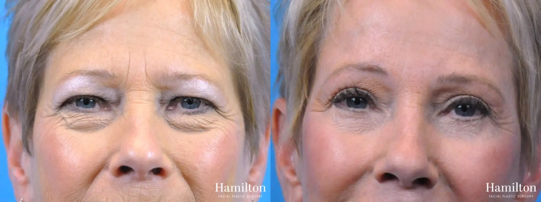 Blepharoplasty: Patient 4 - Before and After  