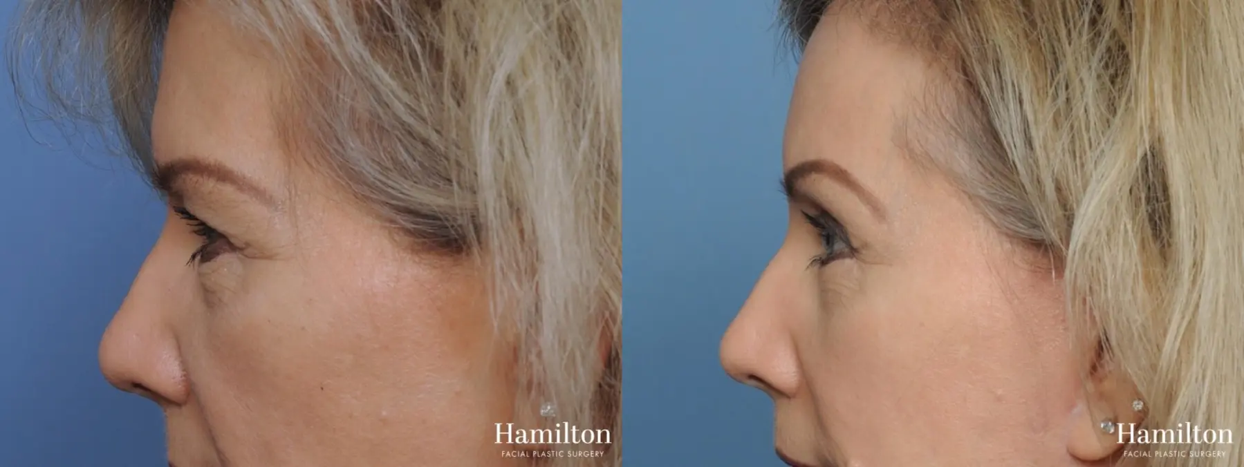 Blepharoplasty: Patient 5 - Before and After 4