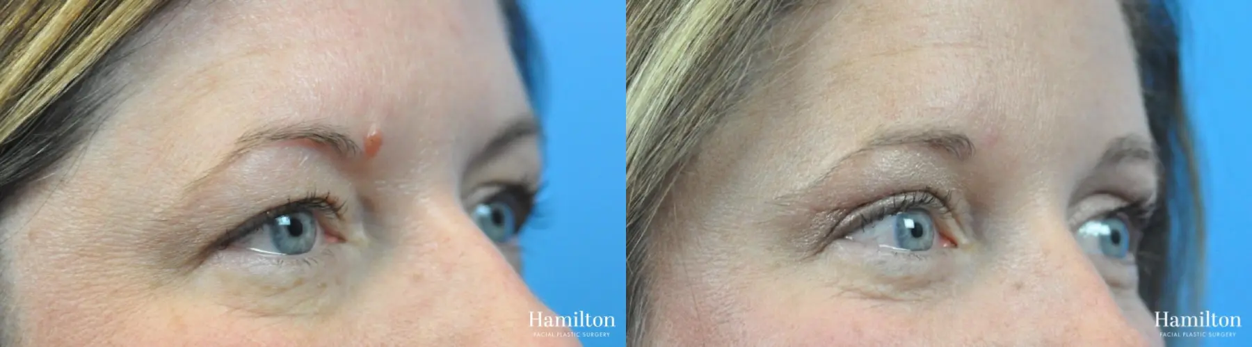 Blepharoplasty: Patient 17 - Before and After 3