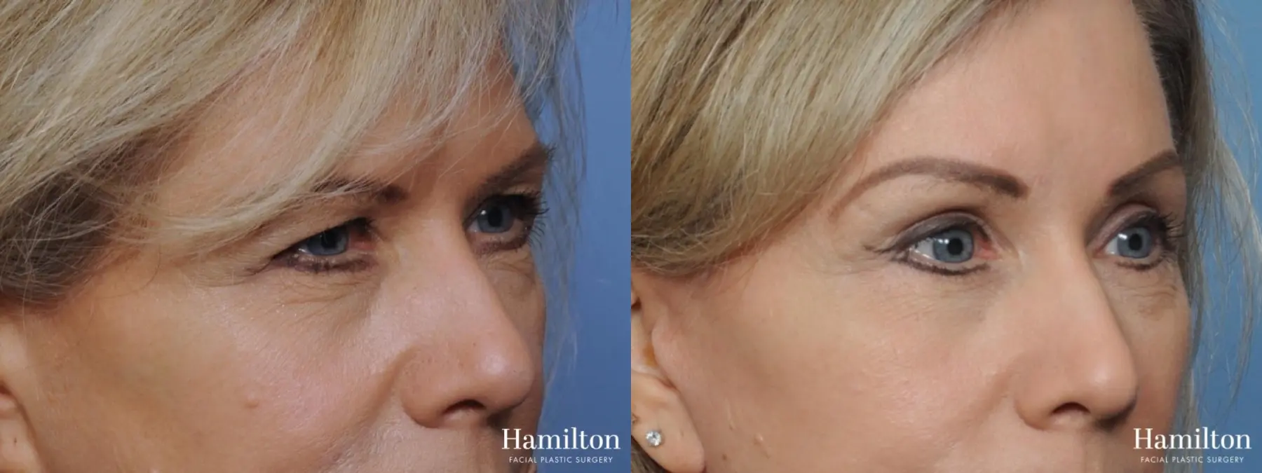 Blepharoplasty: Patient 5 - Before and After  