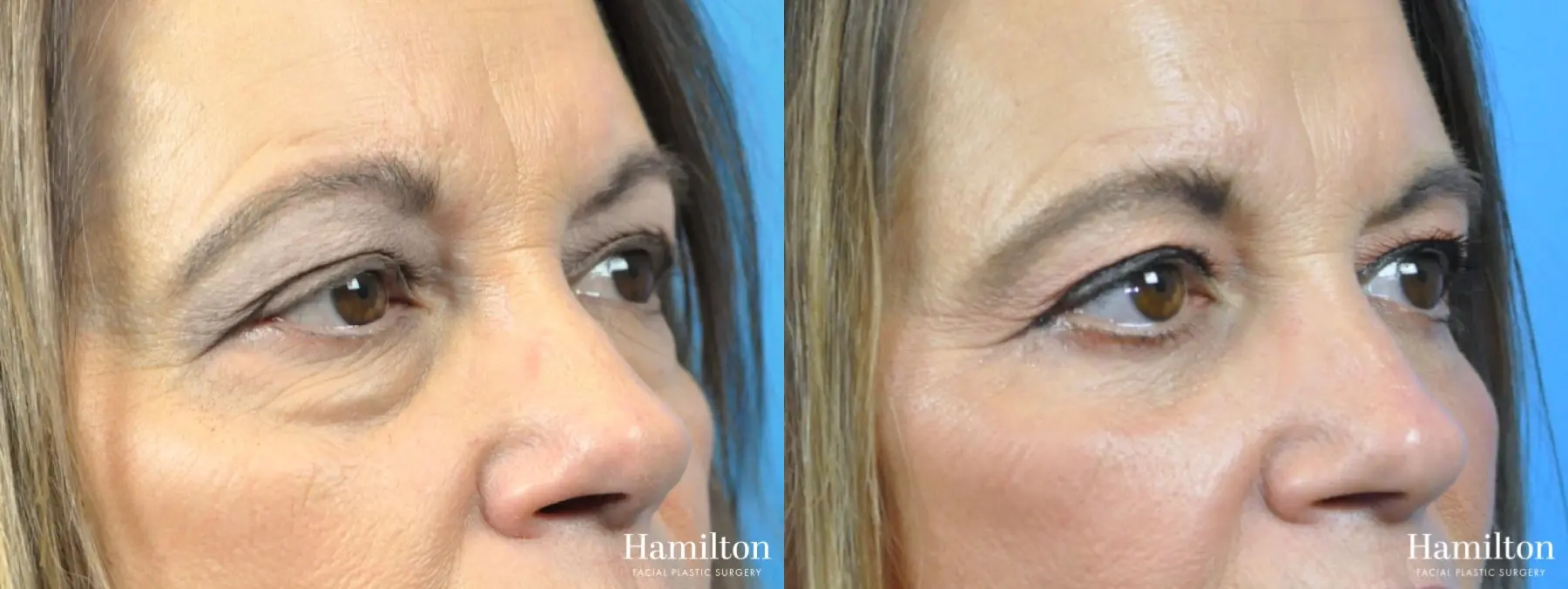 Blepharoplasty: Patient 3 - Before and After 3