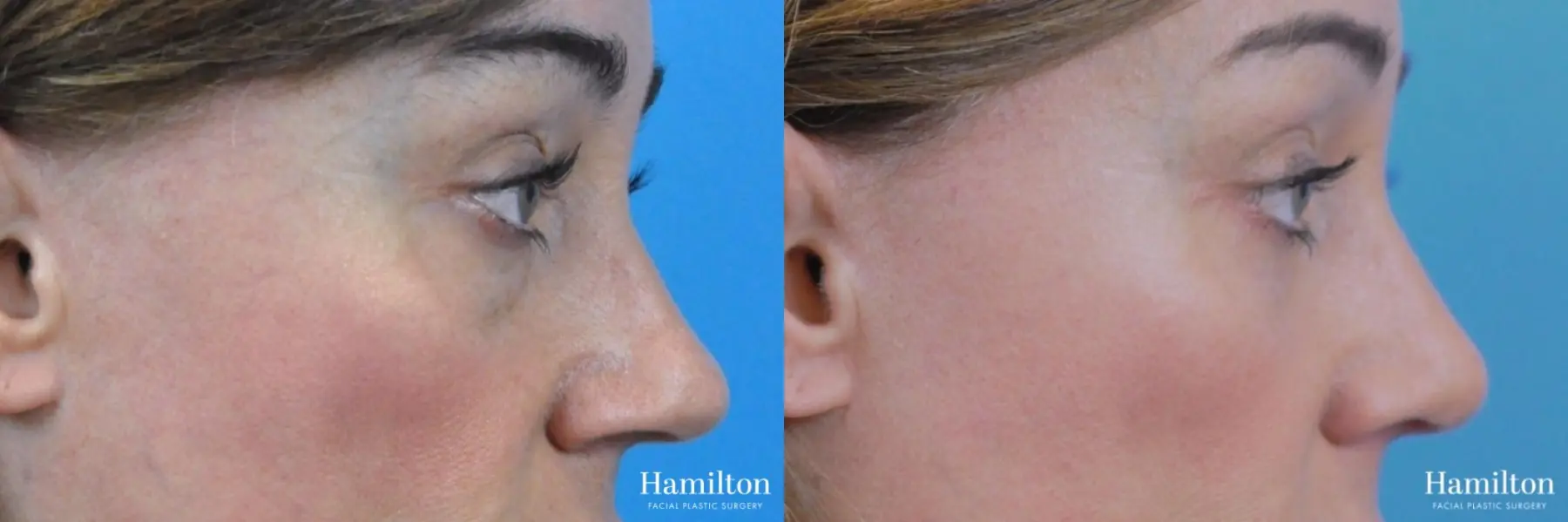 Blepharoplasty: Patient 25 - Before and After 3