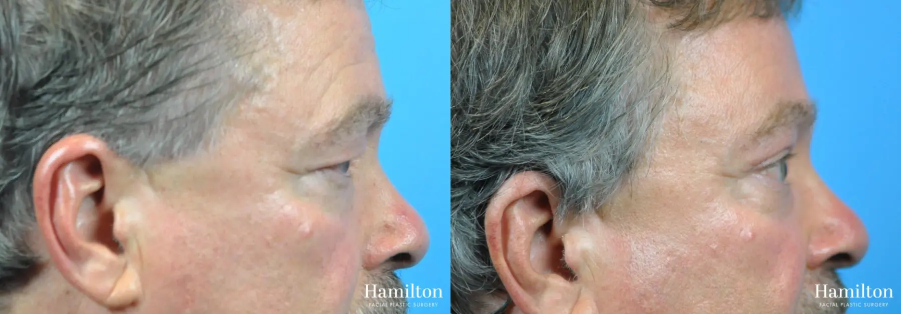 Blepharoplasty: Patient 19 - Before and After 5