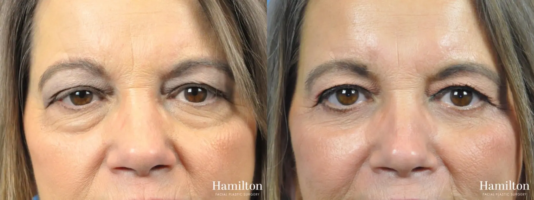 Blepharoplasty: Patient 3 - Before and After 2