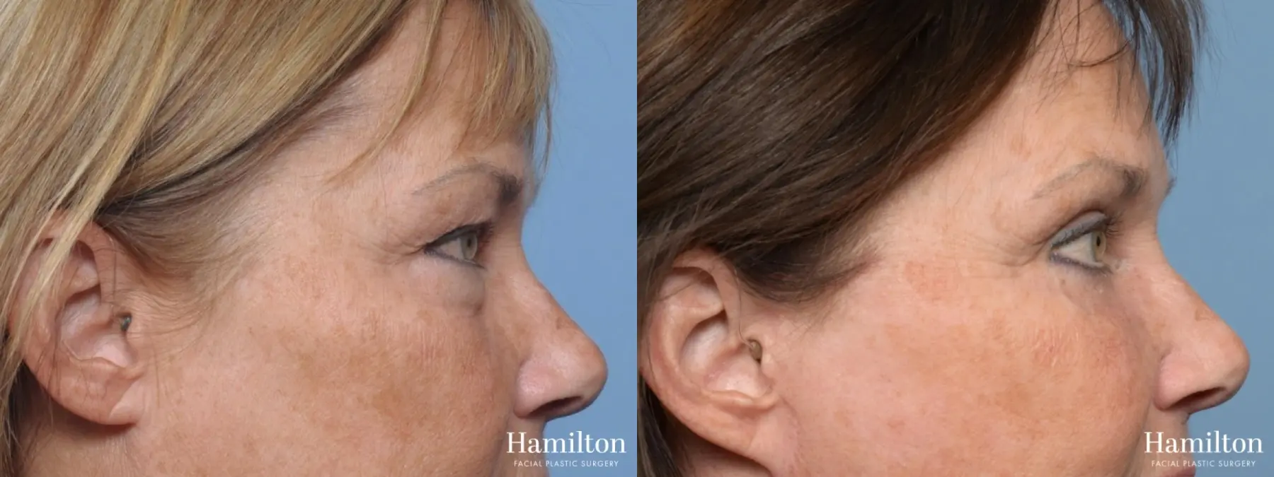 Blepharoplasty: Patient 2 - Before and After 4