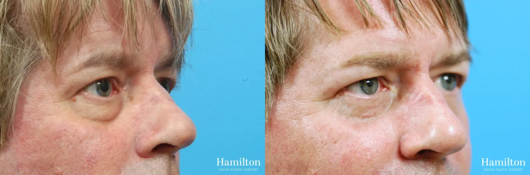 Blepharoplasty: Patient 23 - Before and After 2