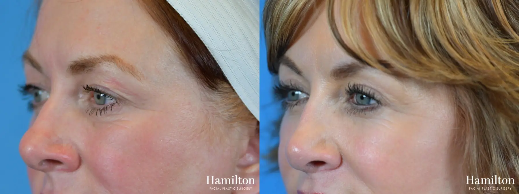 Blepharoplasty: Patient 9 - Before and After 4