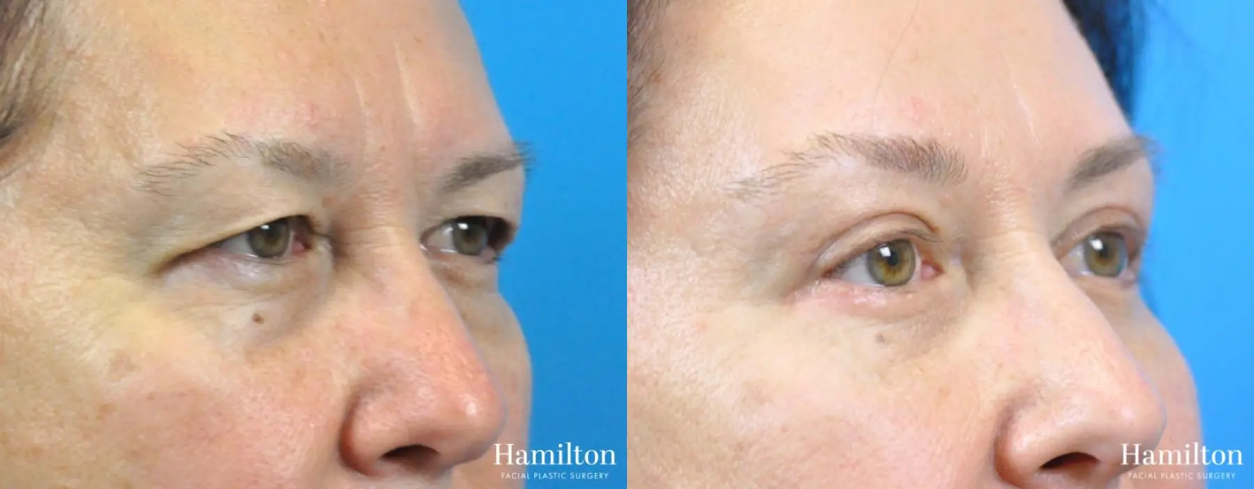 Blepharoplasty: Patient 21 - Before and After 2