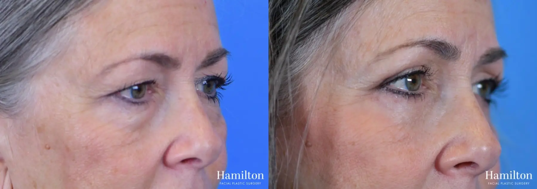 Blepharoplasty: Patient 12 - Before and After 3