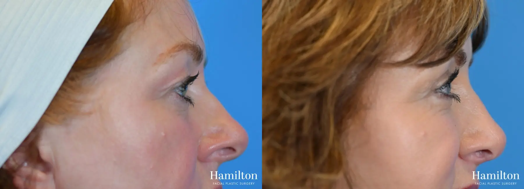 Blepharoplasty: Patient 9 - Before and After 5