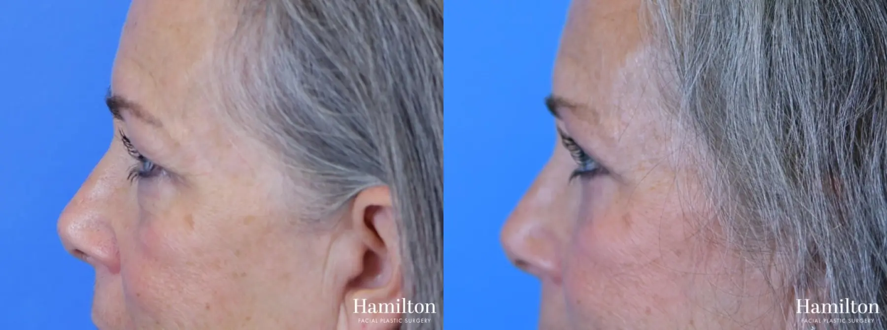 Blepharoplasty: Patient 12 - Before and After 5