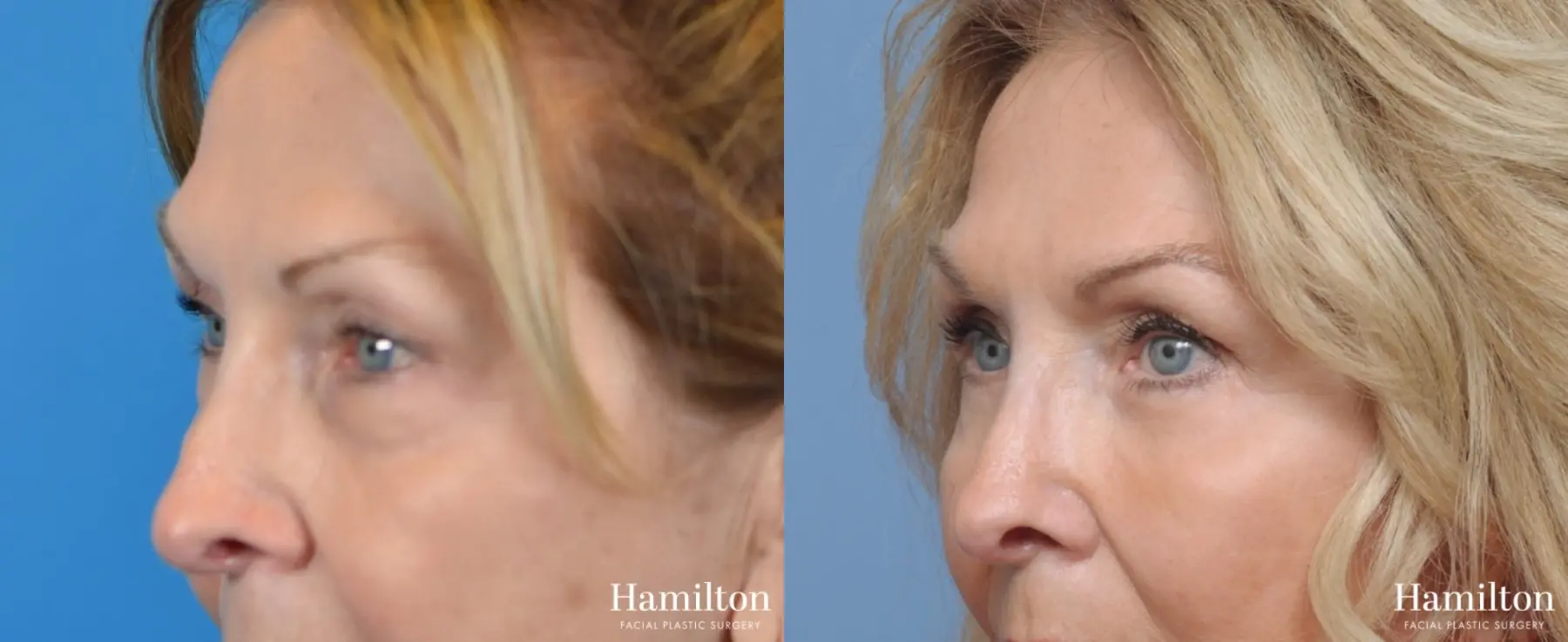 Blepharoplasty: Patient 1 - Before and After 4