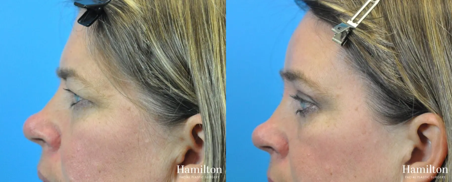 Blepharoplasty: Patient 16 - Before and After 4