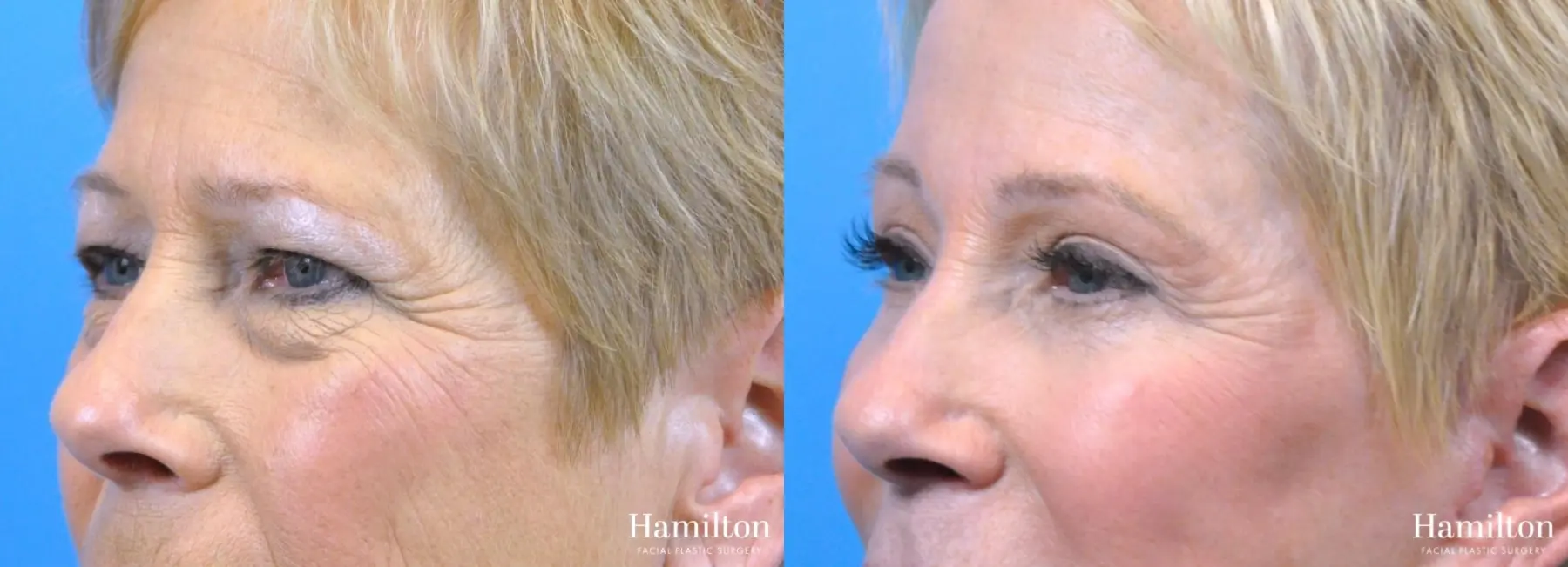 Blepharoplasty: Patient 4 - Before and After 2