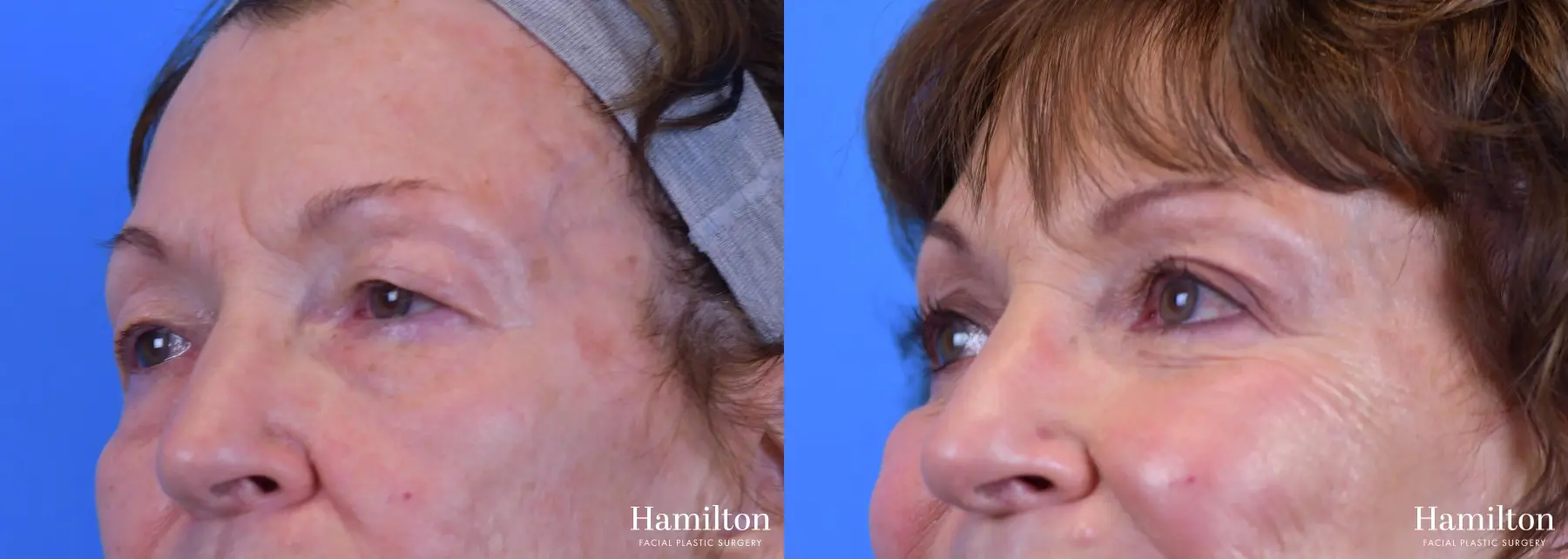 Blepharoplasty: Patient 13 - Before and After 4