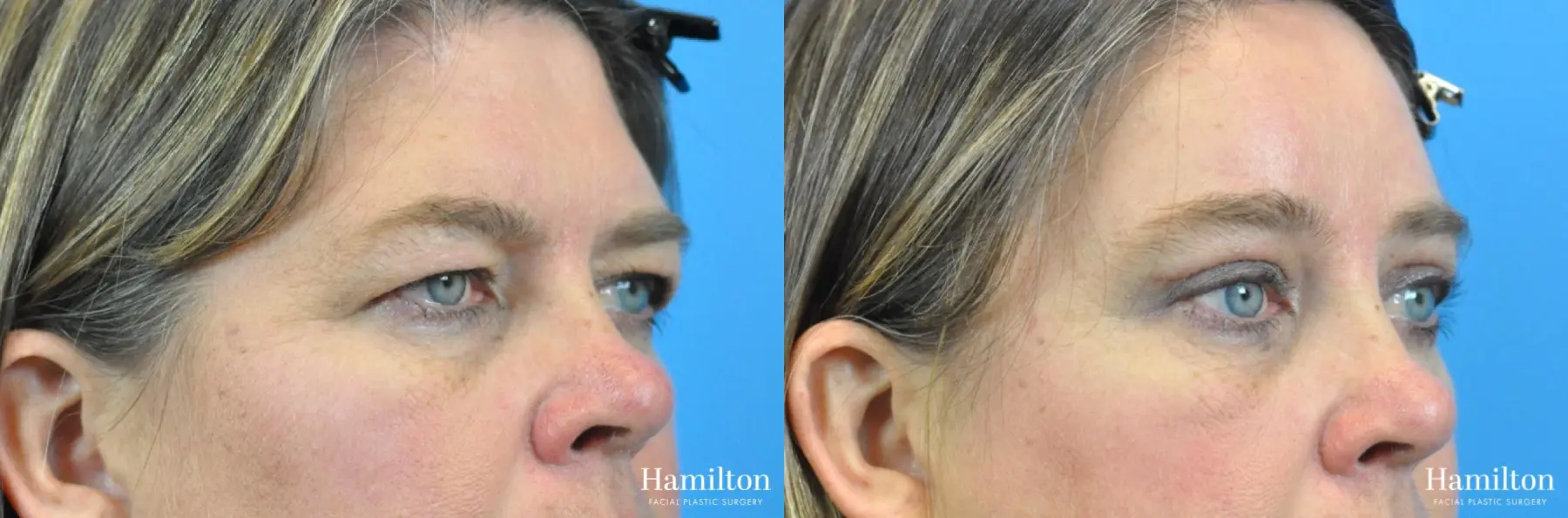 Blepharoplasty: Patient 16 - Before and After 2