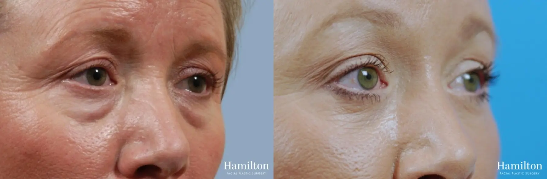 Blepharoplasty: Patient 11 - Before and After 2