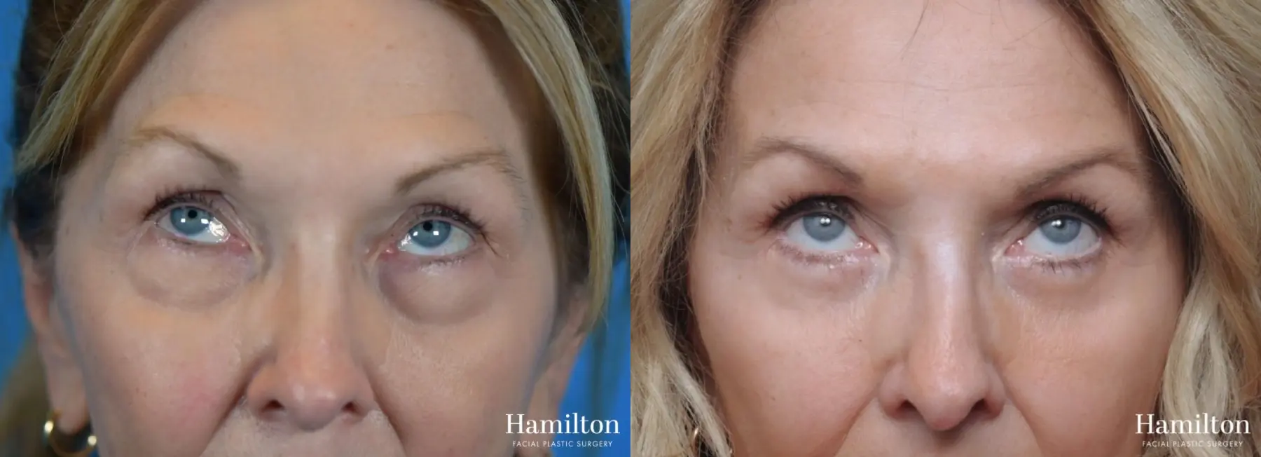 Blepharoplasty: Patient 1 - Before and After  