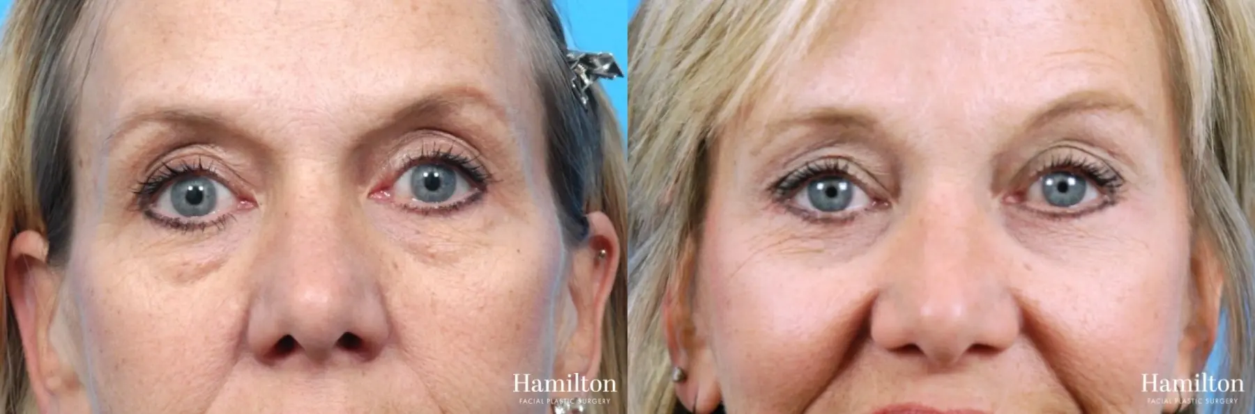 Blepharoplasty: Patient 8 - Before and After  