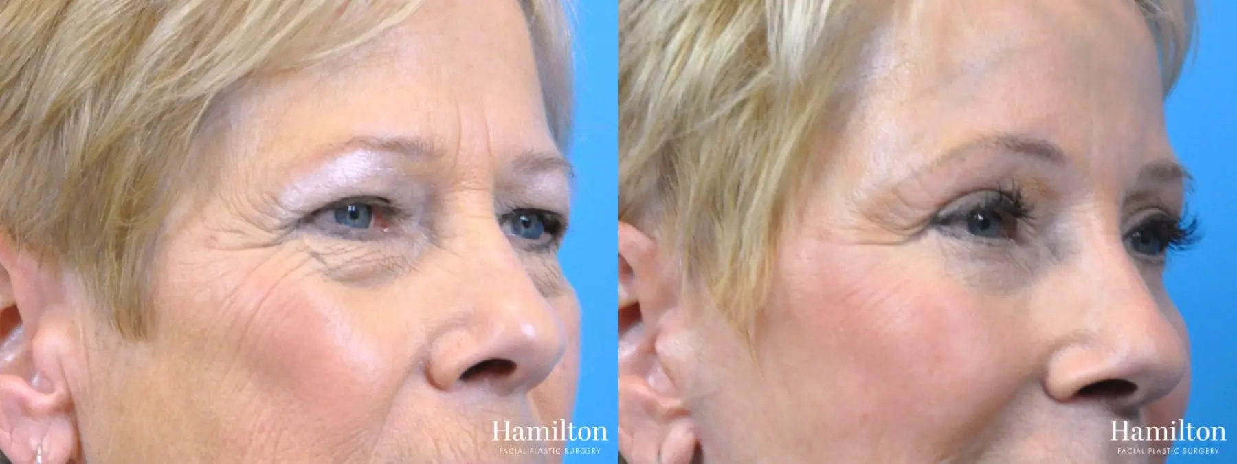 Blepharoplasty: Patient 4 - Before and After 3