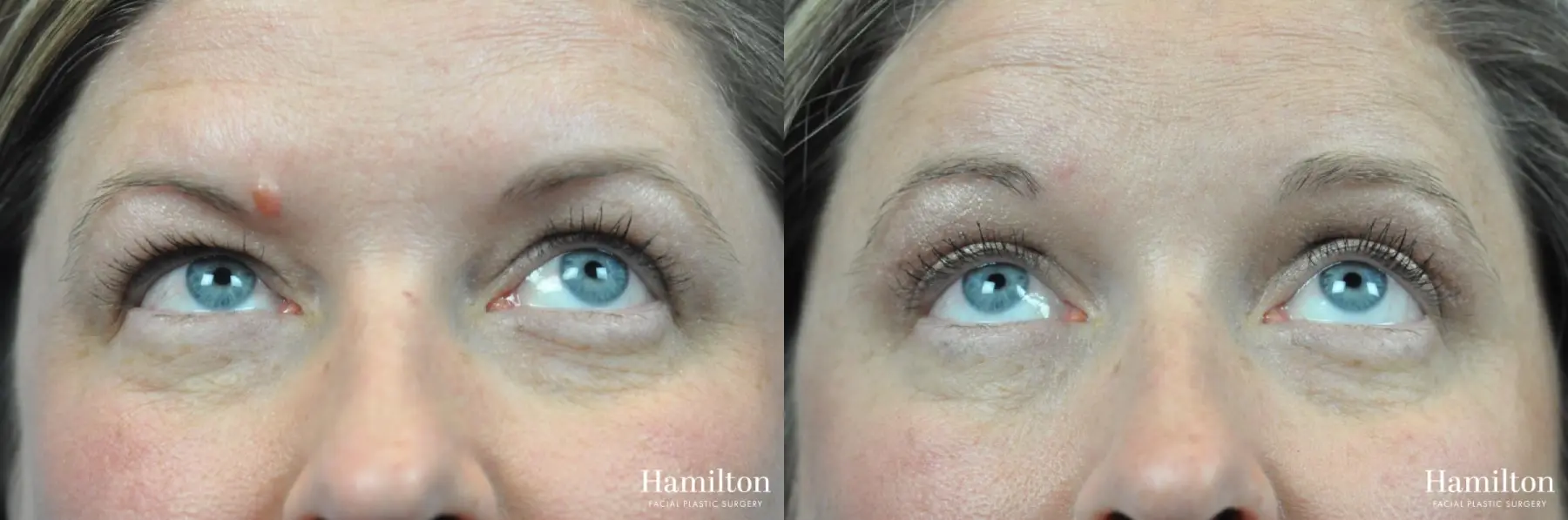 Blepharoplasty: Patient 17 - Before and After 2