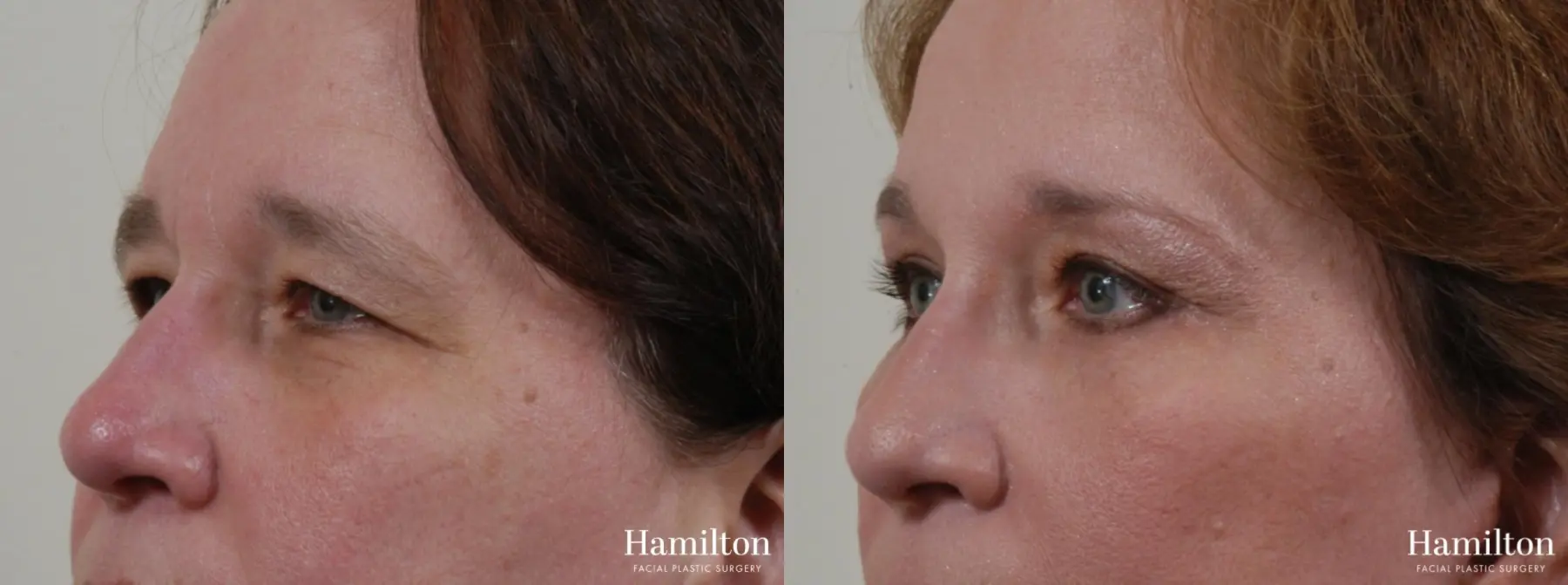 Blepharoplasty: Patient 7 - Before and After 2